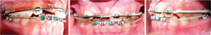 At month 6: a 0.036 stainless steel accessory archwire was placed and the incisor was tractioned with elastomeric ligature. This procedure was continued for three more months.