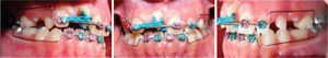10th month: a 0.016 stainless steel utility archwire was placed on the upper and lower arches. The open coil was maintained for space preservation and a couple was made with elastomeric chains to align the upper right central incisor. This procedure was continued for two more months.
