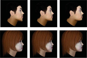 Imágenes de perfil facial modificadas en el tercio inferior de la cara por un software para obtener los perfiles dolicofacial, proporcionado y braquifacial.