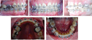 Transoperatory intraoral photographs right side, frontal view left side and upper and lower occlusal photographs.