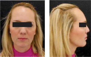 Final facial frontal and right proﬁle photographs.