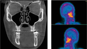 Frontal tomographic slice that shows the maxillomandibular discrepancy. Gammagraphy that shows the end of metabolism and active cell proliferation in the mandible.