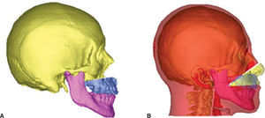 Simulación virtual del avance maxilar. A) Osteotomía Le Fort I y avance de 12mm que corrige la discre-pancia maxilo-mandibular inicial. B) Predicción de la proyección de los tejidos blandos.