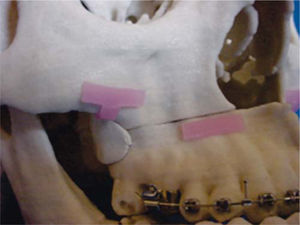 Modelos de los anclajes en cera. En el diseño del anclaje malar se considera espacio para tres tornillos de fijación y para el anclaje de los segmentos maxilares se considera espacio para dos tornillos.