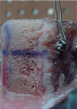 Alambre introducido por el orificio de la cabeza del miniimplante.