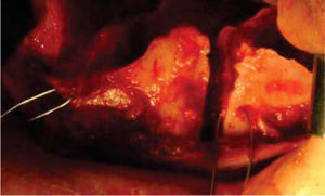 Cirugía segmentaría posterior izquierda del maxilar.