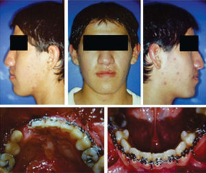 Patient with unilateral cleft lip and palate. In the upper images, a facial middle third depression may be observed and in the lower images, the proper alignment of the dental arches.