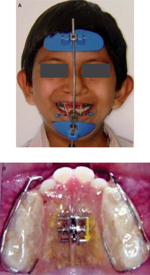 (A) Protraction facial mask. (B) Appliance of rapid palatal expansion with acrylic on the occlusal face.