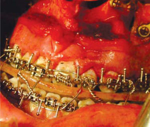 Intermediate splint: it is used at half the intervention to achieve a correct position of the maxilla.