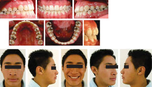 Intraoral and extra oral photographs after the removal of fixed appliances.