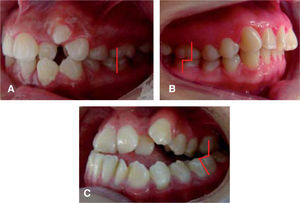 Prevalencia de la clase molar de Angle. A) Clase I, masculino 43.66%, femenino 36.84%. B) Clase molar II, masculino 12.67%, 21.05% femenino. C) Clase III molar, 15.49% masculino, 6.57% femenino.