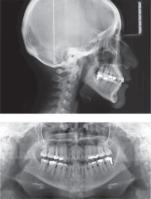 Radiografías finales lateral de cráneo y panorámica.