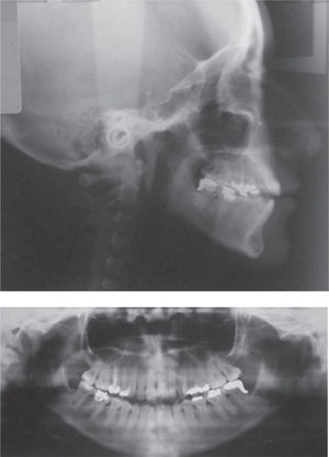 Radiografía lateral de cráneo y radiografía panorámica.