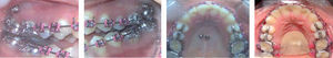 Colocación de los mini-implantes en maxila (paladar y zona vestibular de los molares), activación del movimiento de intrusión con ayuda de cadena cerrada.