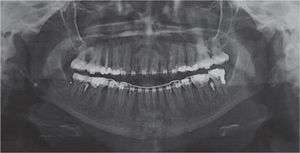 Radiografía que muestra la colocación de los mini-implantes en la mandíbula entre el primer y segundo molar izquierdo y derecho.