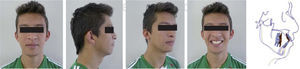 Fotografías extraorales finales.