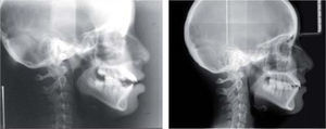 Comparativos de cefalografía lateral de cráneo inicial y final que muestran los cambios esqueléticos y dentales.