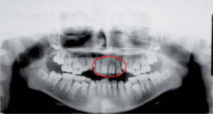 Ortopantomografía inicial en donde se observa el acortamiento radicular de los incisivos anteriores superiores.