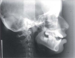 Cefalografía lateral de cráneo mostrando la hiperdivergencia mandibular, así como proinclinación incisiva severa.