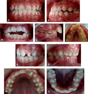 Malocclusion prevalence. A) 12.8% anterior cross bite, frontal and lateral view. B) 35.1% anterior open bite. C) Overjet, lteral and occlusal view (7.45%). D) Edge to edge bite. E) Overbite. F) 19.6% upper anterior crowding. G) 26.4% lower anterior crowding.