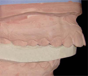 Lower cast mounting guides with the gothic arch tracing technique. Lateral view.