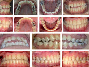Comparison between the initial and ﬁnal intraoral photographs.