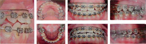Mini-implant placement on the mandible, active lingual arch and in the maxilla, active buccal accessory arch.