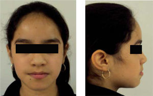 Frontal and lateral facial photographs. Increased lower third and chin muscle hypertonicity may be observed.