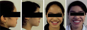 Pre and post-treatment smile photographs in which facial changes may be observed.