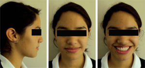 Six months post-treatment facial photographs.