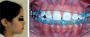 Photographs after two years of treatment. A decrease in the lower facial third and lip competence may be noticed as well as the correction of the anterior open bite correction.