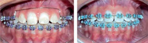 A. Utility-type archwire placement in the anterior segment. B. Intraoral photographs four months after placing ﬁ xed appliances on the upper incisors.