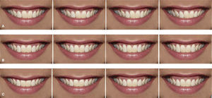 A) Modificaciones para «línea media». B) Modificaciones para «margen gingival». C) Modificaciones para «exposición gingival».