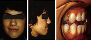 Fotografías extraorales e intraorales de una paciente adulta con fisura labiopalatina antes de recibir tratamiento ortodóncico, quirúrgico y rehabilitación protésica.