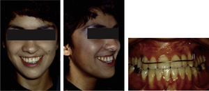 Fotografías extraorales e intraorales de una paciente adulta con fisura labiopalatina después de recibir tratamiento ortodóncico, quirúrgico y rehabilitación protésica durante su infancia y adolescencia.