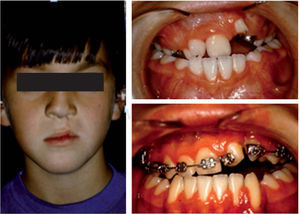 Fotografías extraorales e intraorales de un paciente adolescente con fisura labiopalatina antes de recibir tratamiento ortopédico, ortodóncico y/o quirúrgico durante su infancia y adolescencia.