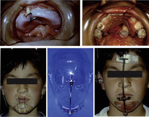 Example of the appliances used for orthopedic treatment during his childhood and adolescence.
