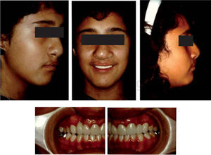 Photographs of an adult patient with cleft lip and palate who received orthodontic, surgical and prosthetic treatment during childhood and adolescence.