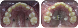 Muestra sitios de inserción de los microtornillos y la placa de acrílico quedando despegada de las coronas de los dientes posteriores, para evitar movimiento de compensación dentoalveolar.