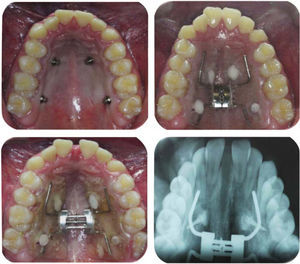 The screws used were Hyrax-type but it may also be a Hass or any other kind of screw just as the amount of activations varies according to the operator's criteria. Notice that the acrylic is not over the clinical crowns.