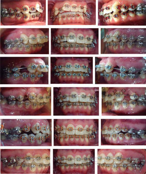 Secuencia del tratamiento.