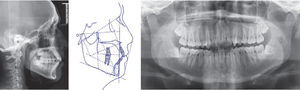 Initial panoramic X-ray and lateral headfilm.
