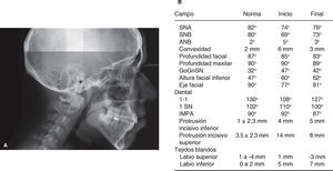 A) Radiografía final lateral de cráneo. B) Análisis cefalométrico.