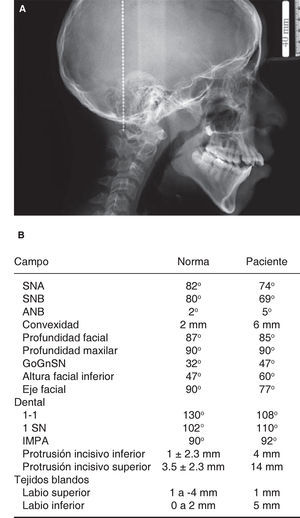 A) Radiografía inicial lateral de cráneo. B) Análisis cefalométrico.