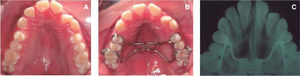 Expansión del maxilar. A) Fotografía que muestra la compresión del maxilar superior. B) Fotografía del maxilar expandido con Hyrax. C) Radiografía que denota la expansión del maxilar.