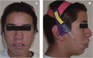 Fotografías del paciente utilizando el arco extraoral de tracción alta, vista frontal (A) y vista sagital (B).