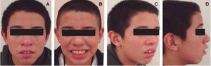 Facial analysis. Initial facial photographs where lip incompetence may be observed (A-D) as well as the chin muscle hyperactivity (A and C) and a 100% exposure of the clinical crowns of the upper front teeth (B).
