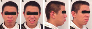 Final facial photographs. A, C and D) Improved lip competence. B) More esthetic smile.