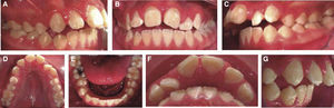 Intraoral clinical exam. Initial intraoral photographs. A and C) Bilateral molar class I, bilateral canine class II and multiple interdental gaps, B) anterior open bite, D and E) lack of intra-arch coordination. Overbite (F), overjet (G).