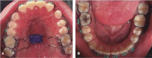 A) Photograph of the palate with the low double transpalatal bars with acrylic button. B) Photograph of the lower arch once the aligning and leveling phase was finished.
